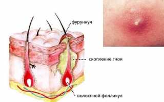 Причины образования фурункулов и их лечение