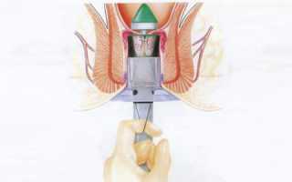 Удаление геморроя методом Лонго