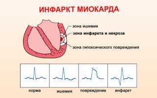 Рубец после инфаркта миокарда