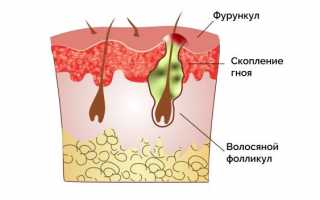 Как можно ускорить созревание фурункула