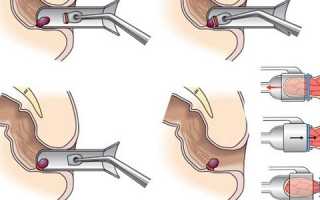Лигирование геморроя латексными кольцами: что это такое и когда назначается?