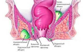 Симптомы и лечение гнойного геморроя