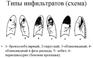 Послеоперационный инфильтрат