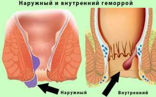 Как отличить внутренний геморрой от внешнего?