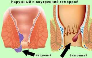 Стадии развития геморроя