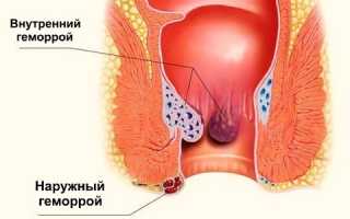 Лечение тромбоза геморроидального узла