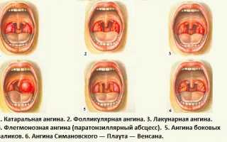 Симптомы и лечение флегмонозной ангины