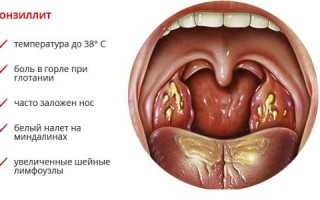 Появился хронический тонзиллит: как избавиться?