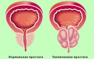 Как лечат геморрой и простатит?