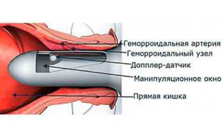 Дают ли больничный лист при геморрое, после операции?