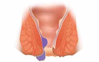 Геморрой на 4 стадии (четвертая степень): симптомы и лечение