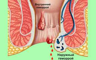 Профилактика геморроя