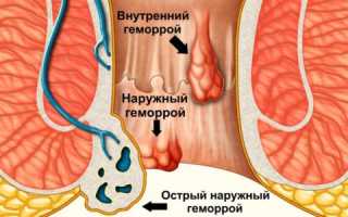 Через сколько дней проходит геморрой и долго ли он лечится