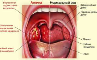 Белый налет на миндалинах – один из признаков ангины