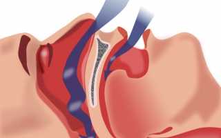 Как лечить апноэ сна