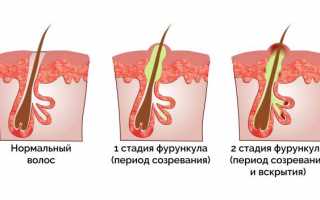 Эффективное лечение фурункула в ухе в домашних условиях