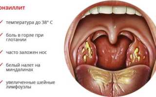 Правильное лечение хронического тонзиллита народными средствами