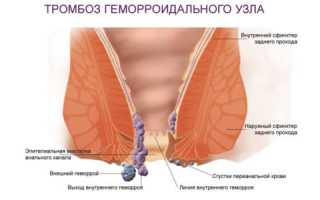 Наружный геморрой: симптомы, причины и методы лечения