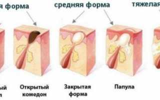 Как эффективно избавиться от прыщей на животе