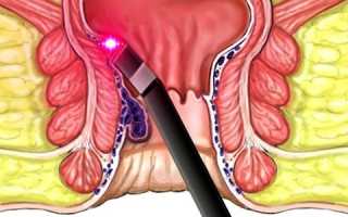 Инфракрасная фотокоагуляция геморроидальных узлов