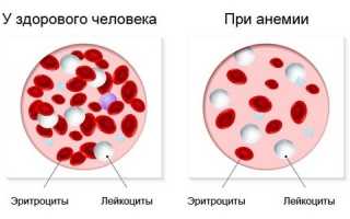 Симптомы и лечение анемии при геморрое