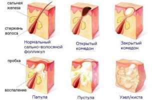 Почему появляются стероидные угри и как их лечить