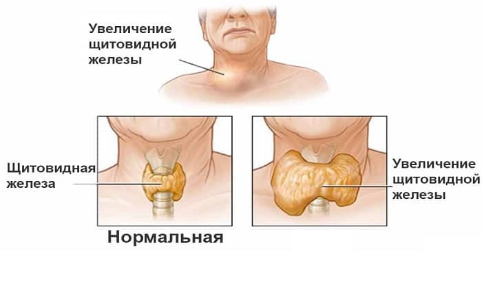 Узловые образования правой доли щитовидной железы представляют собой округлые участки разросшейся железистой ткани