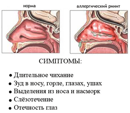 Схема аллергического ринита