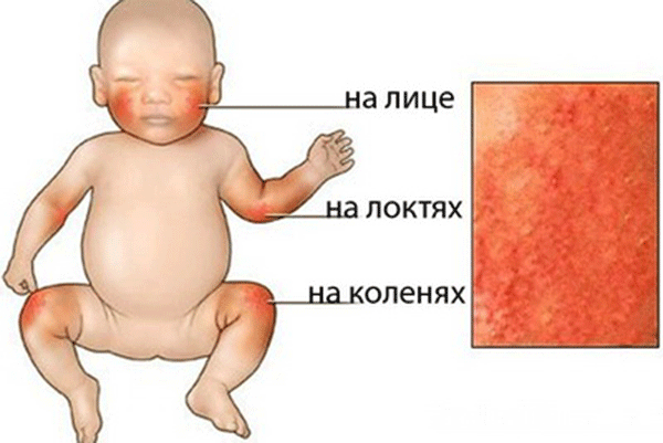 Высыпания на коже от воздействия солнца