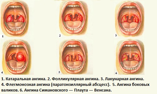 Виды ангины