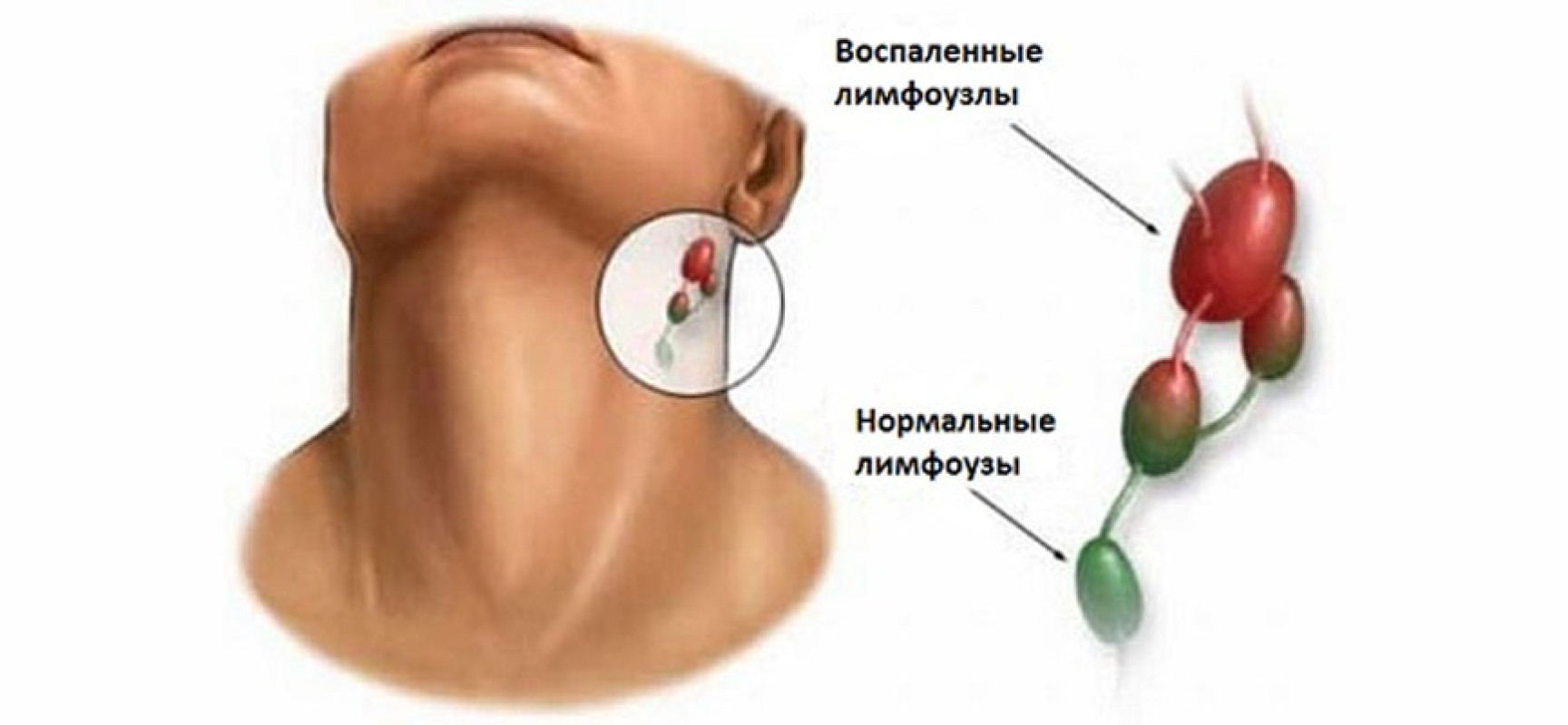 Увеличение лимфатических узлов - симптом дифтерии