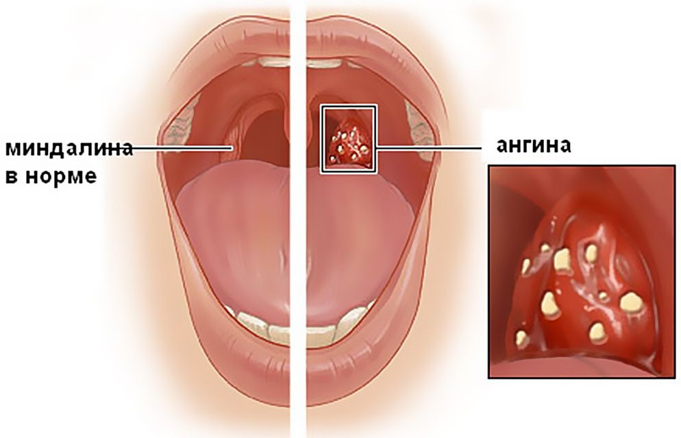 Миндалины при ангине