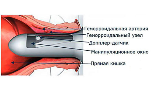 Главная задача геморроидэктомии - это вырезать геморроидальные узлы