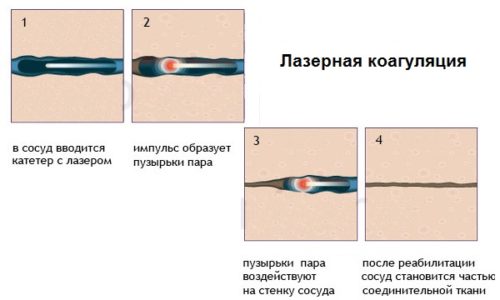 Лазерная коагуляция - современная методика лечения геморроя, основывающаяся на нагревании тканей сфокусированным лучом