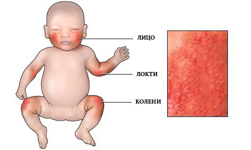 Места появления аллергической сыпи