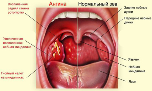 Налет на миндалинах при ангине