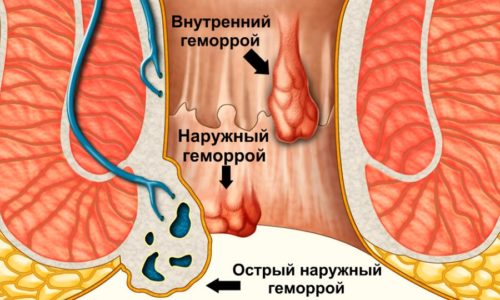 Терапия геморроя зависит от правильной диагностики, поэтому прежде всего нужно определить форму болезни