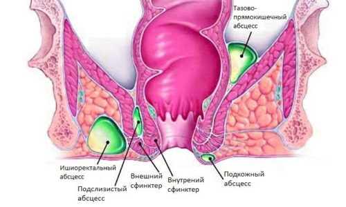 Геморрой с гноем - расширение вен прямой кишки, с образованием абсцессов и нагноением окружающих тканей