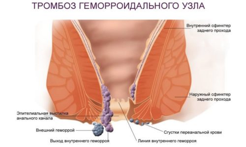 Характерны для наружного типа заболевания, сопровождающегося тромбозом