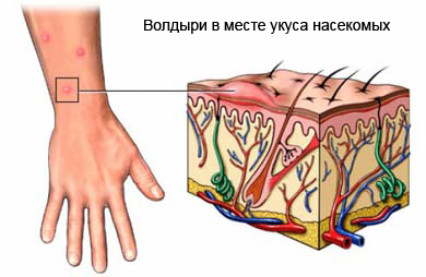 Образование волдырей после укуса комара