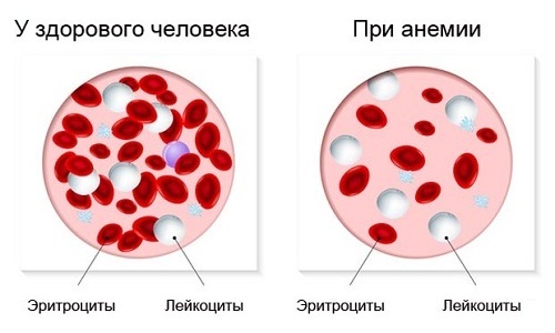 Из-за регулярных потерь циркулирующей жидкости возникает анемия при геморрое - опасное для жизни осложнение