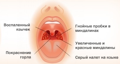 Симптомы гнойной ангины