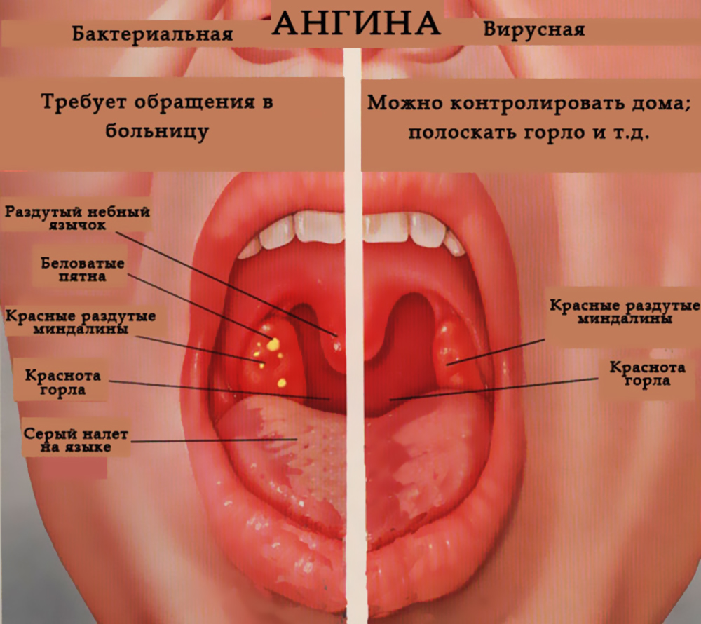 Признаки ангины