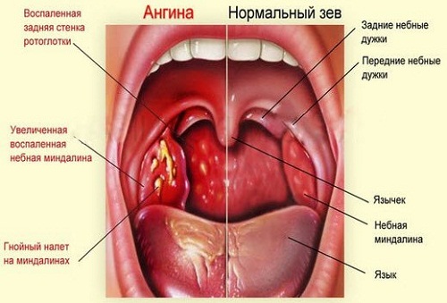 Нормальный зев и зев с ангиной