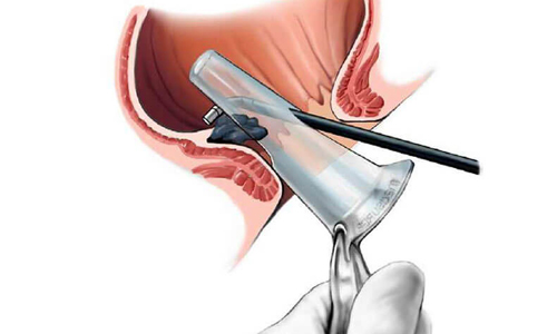 Аноскопия поможет обнаружить полипы