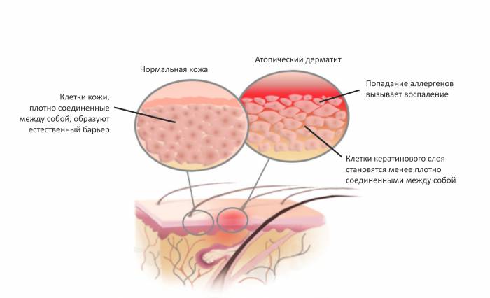 Схема атопического дерматита