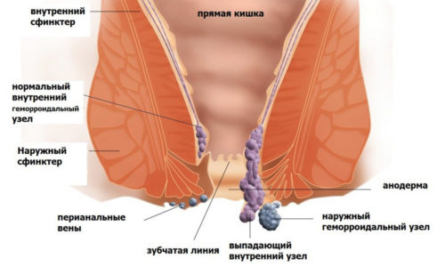 Что такое геморрой. Его симптомы могут иметь сходство с анальной трещиной, раком прямой кишки и другими патологиями