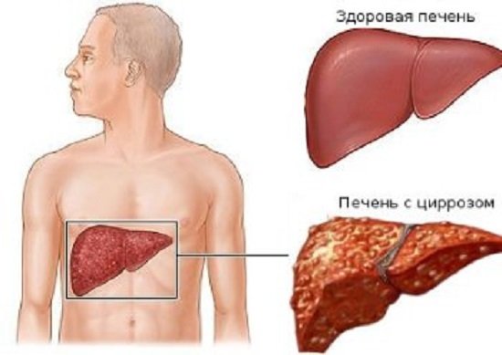 Цирроз - противопоказание к употреблению имбиря