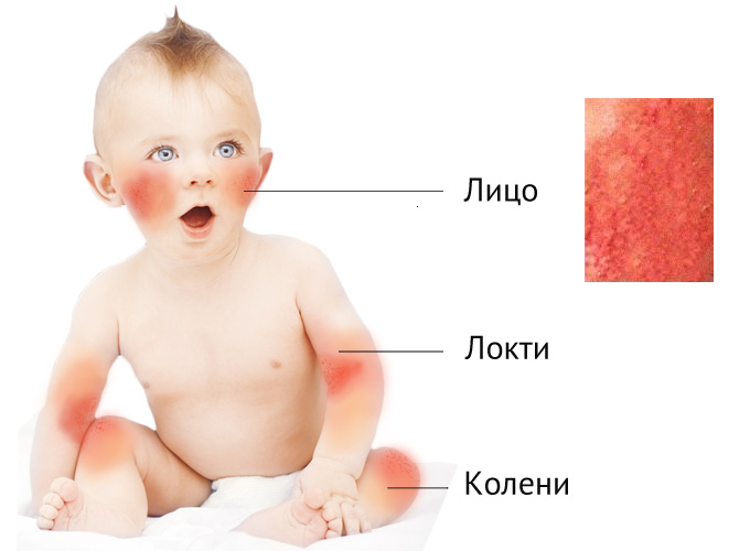 Места поражения аллергическим дерматитом на теле