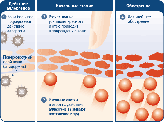 Схема образования аллергического дерматита